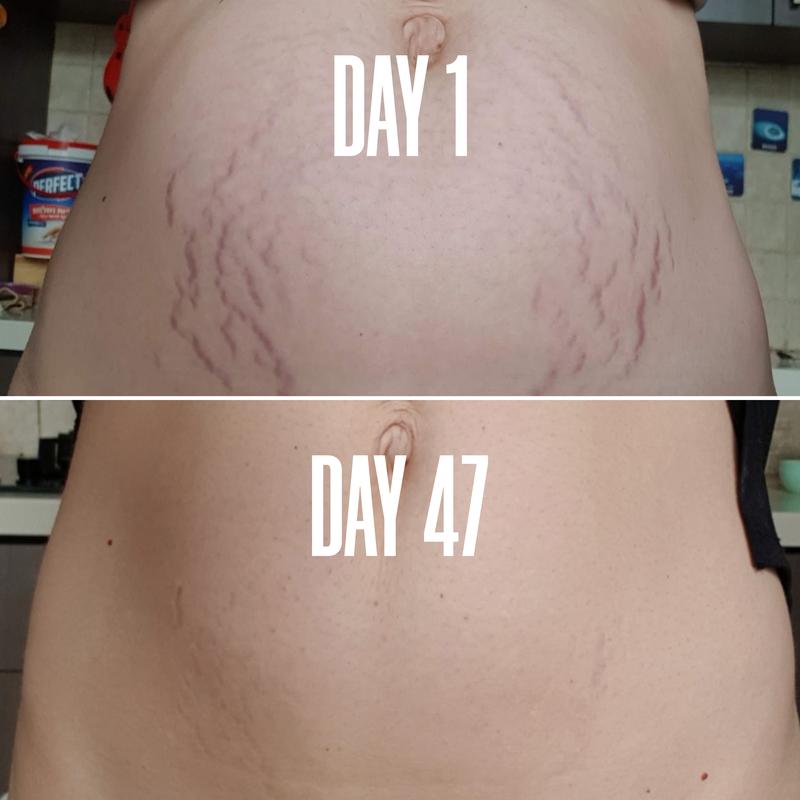 [Clinically Proven] Belly Firming Cream - Belly Oil for Stretch Marks And Loose Skin - With Avocado Extract