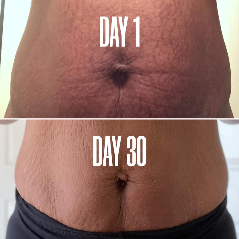 [Clinically Proven] Belly Firming Cream - Belly Oil for Stretch Marks And Loose Skin - With Avocado Extract